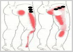 トリガーポイント1