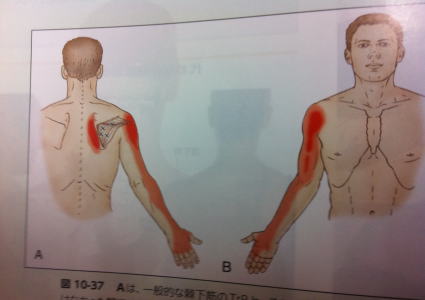 腕の痺れトリガーポイント1