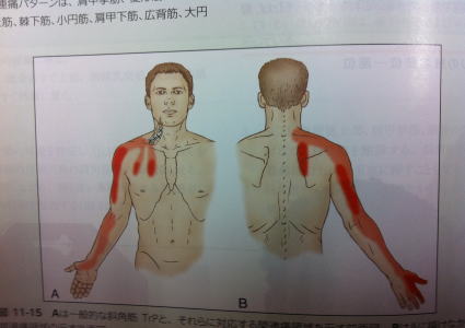 腕の痺れトリガーポイント2