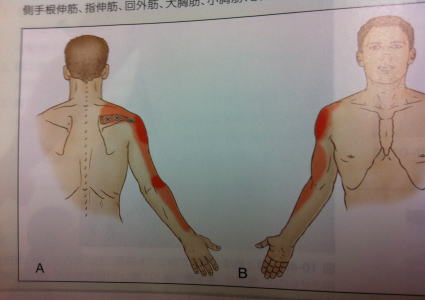 腕の痺れトリガーポイント3